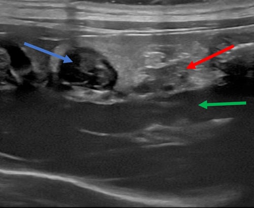 IMAGE 6 Body of the pancreas cat