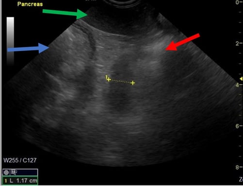 IMAGE 8 Left lobe pancreatitis