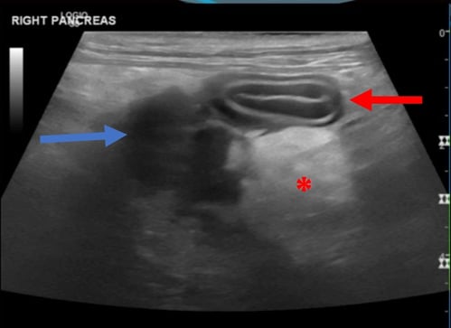 IMAGE 9 Right lobe pancreatitis