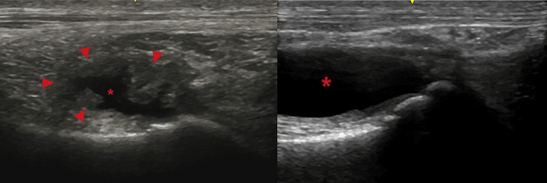 medial femorotibial joint