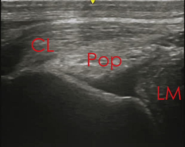 lateral collateral ligament