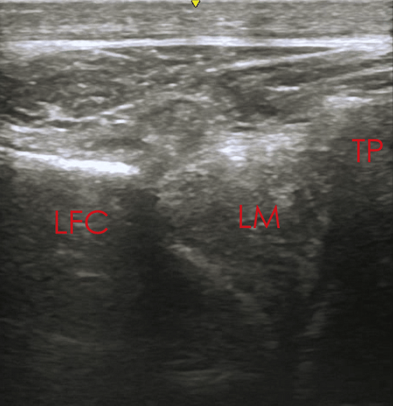 popliteus tendon