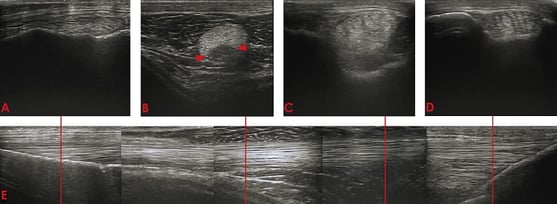 middle patellar ligament