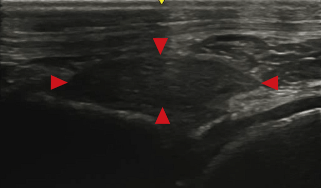 middle patellar ligament