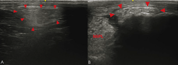 medial patellar ligament
