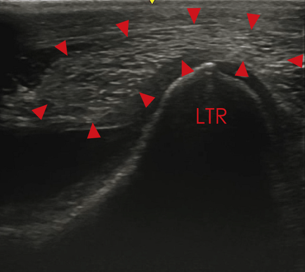 lateral patellar ligament