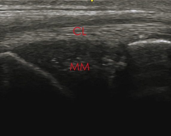 medial collateral ligament
