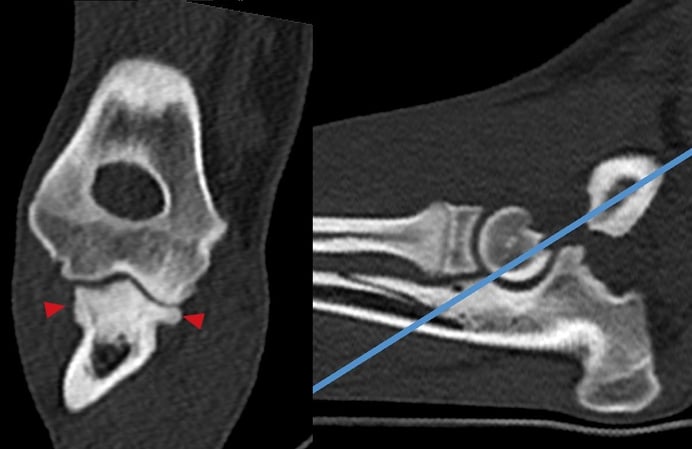 Humeroulnar osteoarthritis