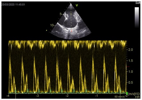 Pulsed wave doppler image courtesy of Emily Dutton at Cheshire Cardiology