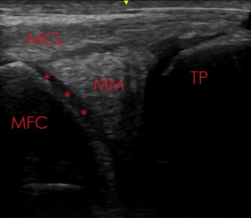 medial femoral condyle