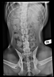 Abdominal x-ray - good exposure, poorly positioned