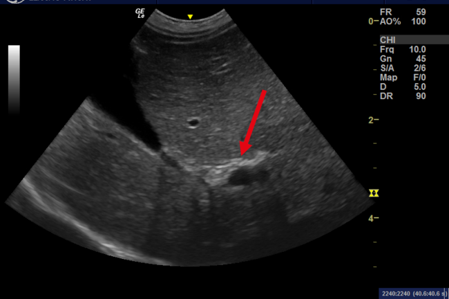 cholelthiasis