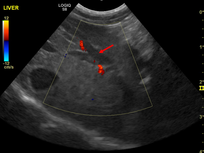 Hepatic duct dilation