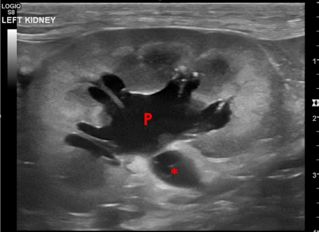 hydronephrosis