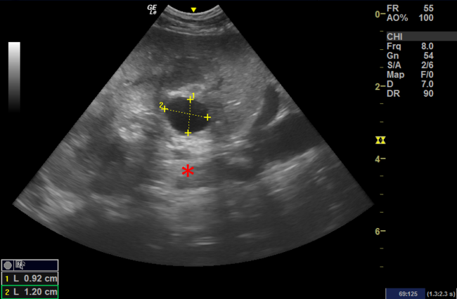 renal cyst