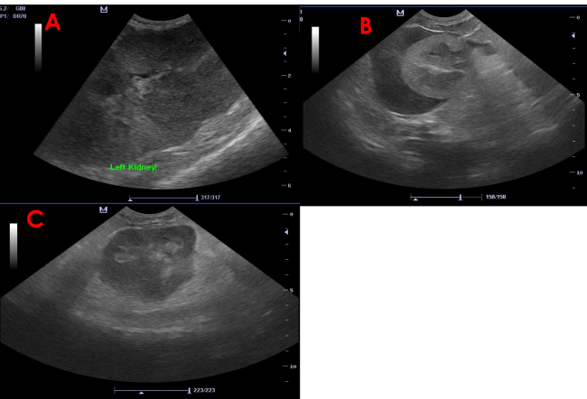 renal neoplasia