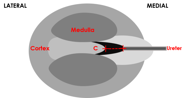 renal pelvis dilatation