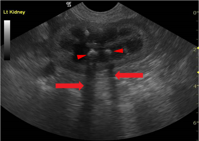 urolithiasis