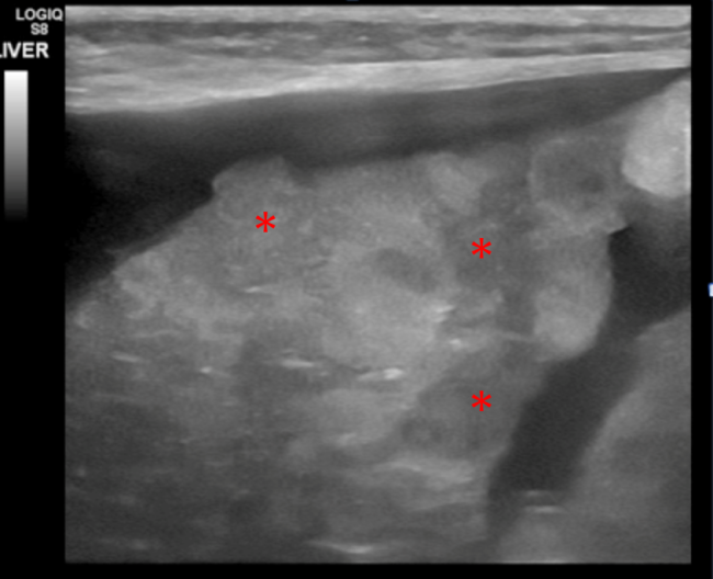Hepatic Cirrhosis