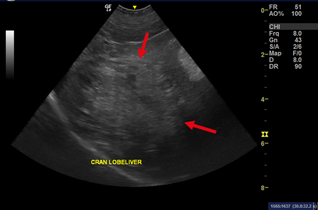 Hepatocellular carcinoma