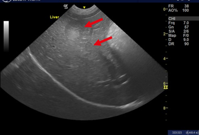 Hepatic metastases