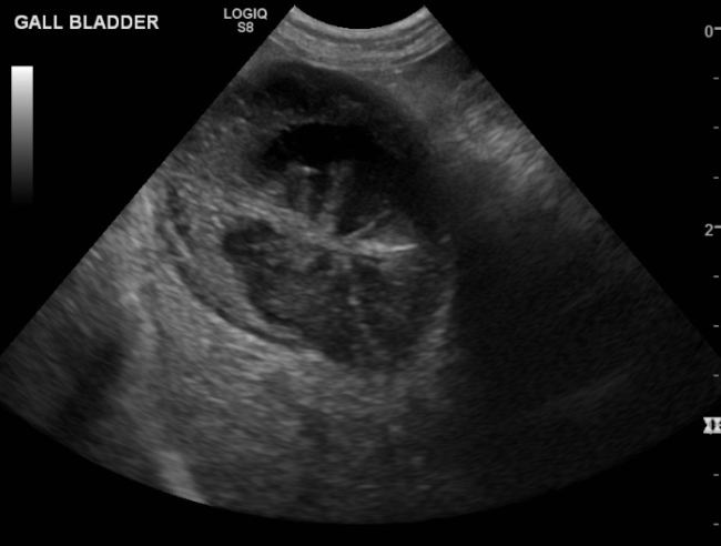 Mucocele