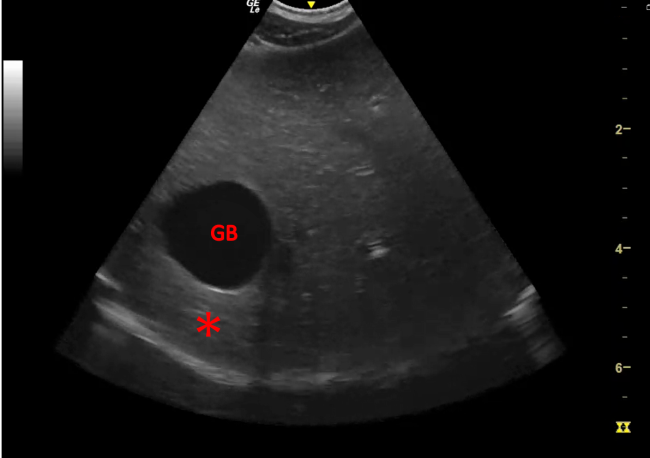 Normal Gall Bladder