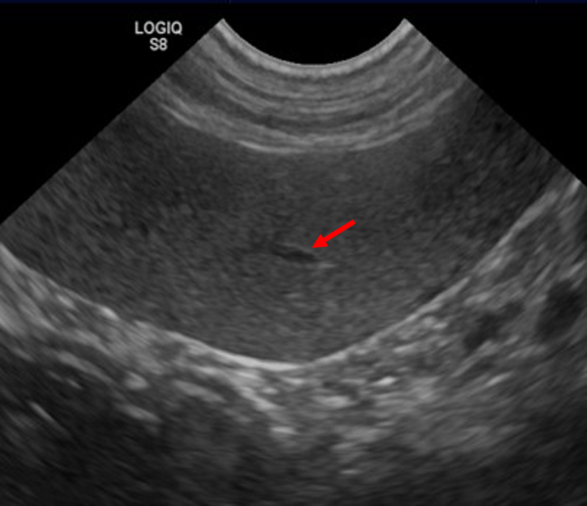 Normal spleen