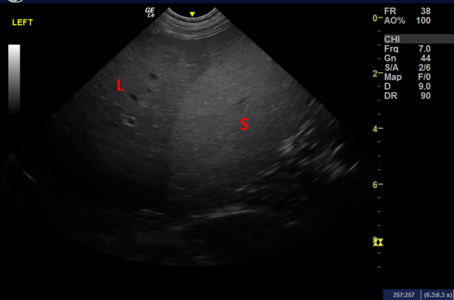 Spleen liver comparison
