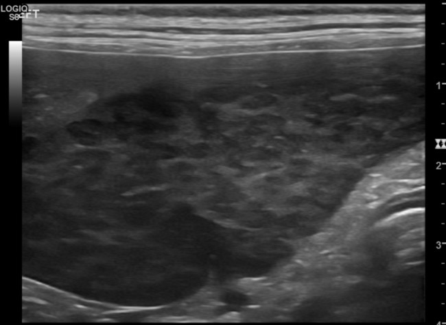 Splenic lymphoma