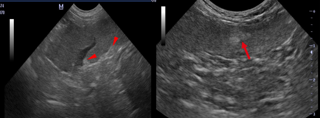 Splenic Myelolipomas
