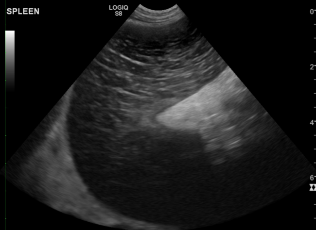 Splenic torsion